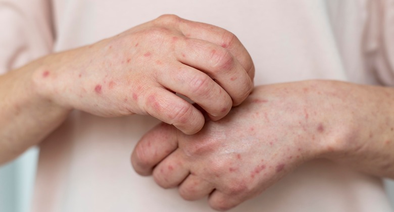 Cacar Monyet – Monkeypox Apakah Sama dengan Cacar Biasa?