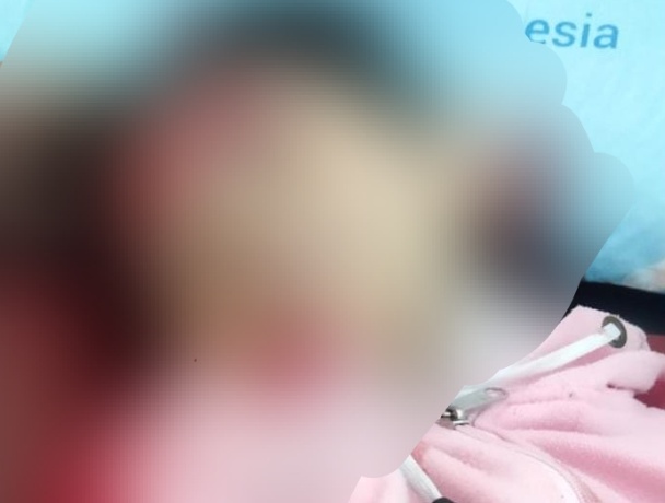 Lawan Penjambret Emas, Siswi Kelas 5 SD di Rajeg Tangerang Alami Luka Sajam di Dahi